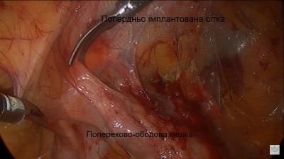Фото 5. Етап операції: лапароскопічне роз’єднання злук, вивільнення попереково-ободової кишки від попередньо встановленої сітки-імпланту