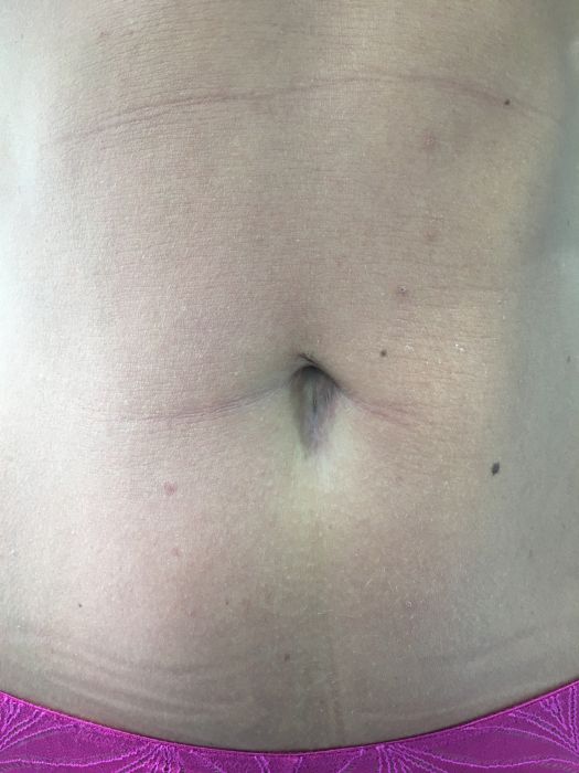 Вид послеоперационного рубца через 2 месяца после проведения SILS-холецистэктомии