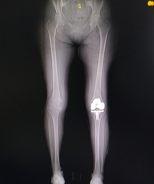 Эндопротезирование коленного сустава в Киеве. Главные рекомендации до и после артропластики колена